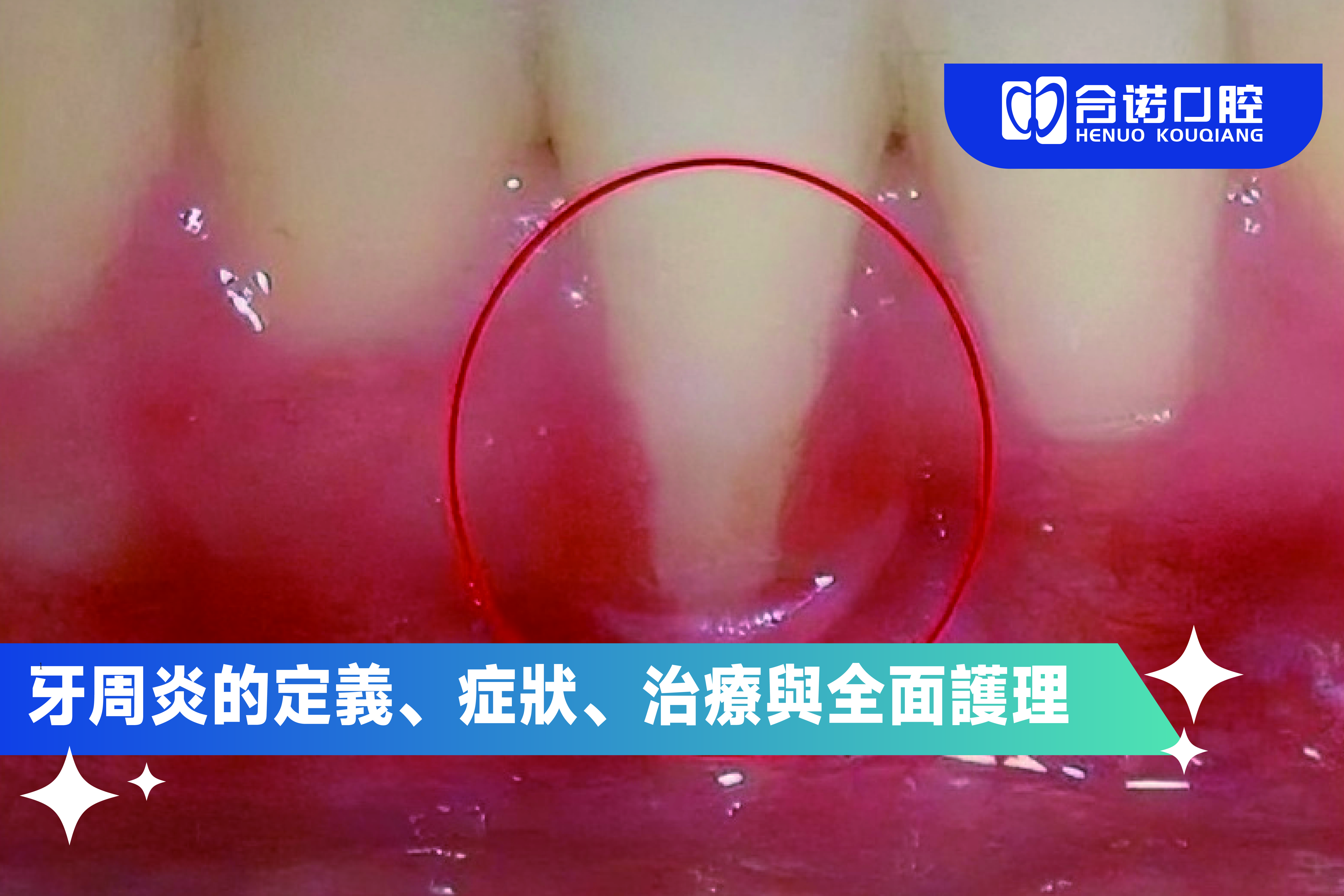 牙周炎的定義、症狀、治療與全面護理指南